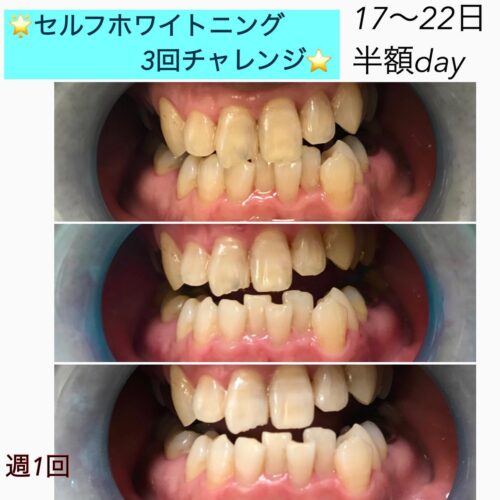 セルフホワイトニング | セレクトサロンガーデン